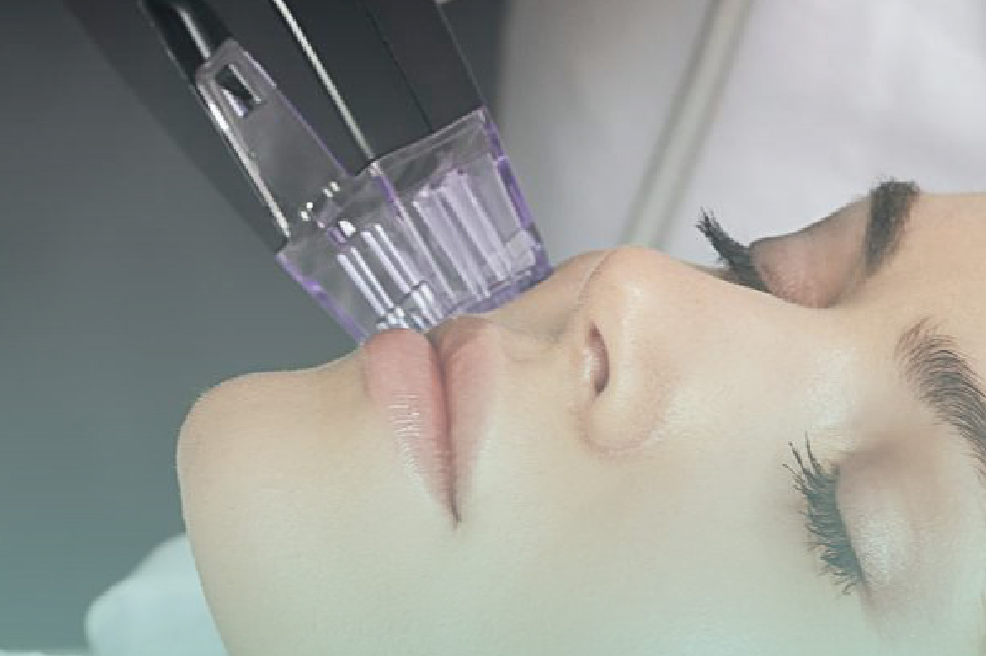 Morpheus 8 Dubai | RF Microneedling Treatment